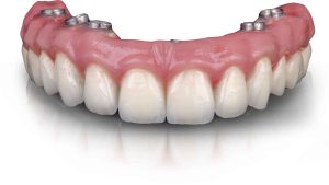 השתלות שיניים, שיקום הפה וטיפולים אסתטיים