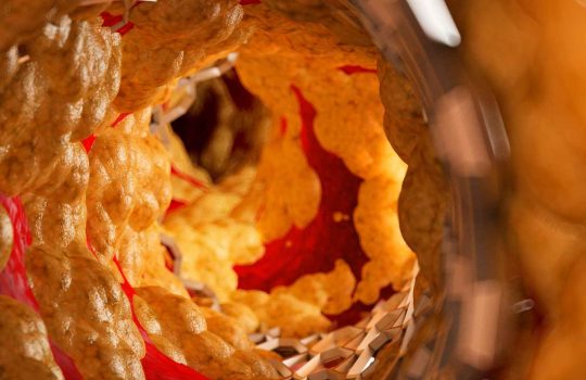 medical implants for the treatment of vascular diseases2